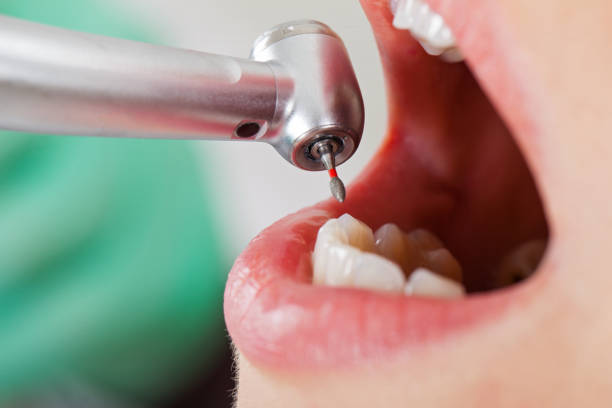 Best Emergency Treatment for Dental Infections or Abscesses in El Paso, IL